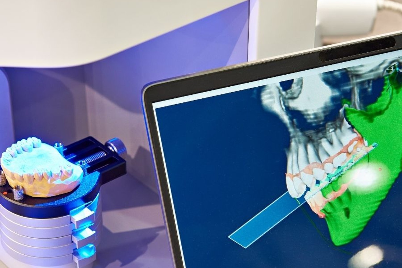 Modello in gesso dell'arcata dentale nello scanner 3D accanto a un monitor con ricostruzione digitale di mascella e denti