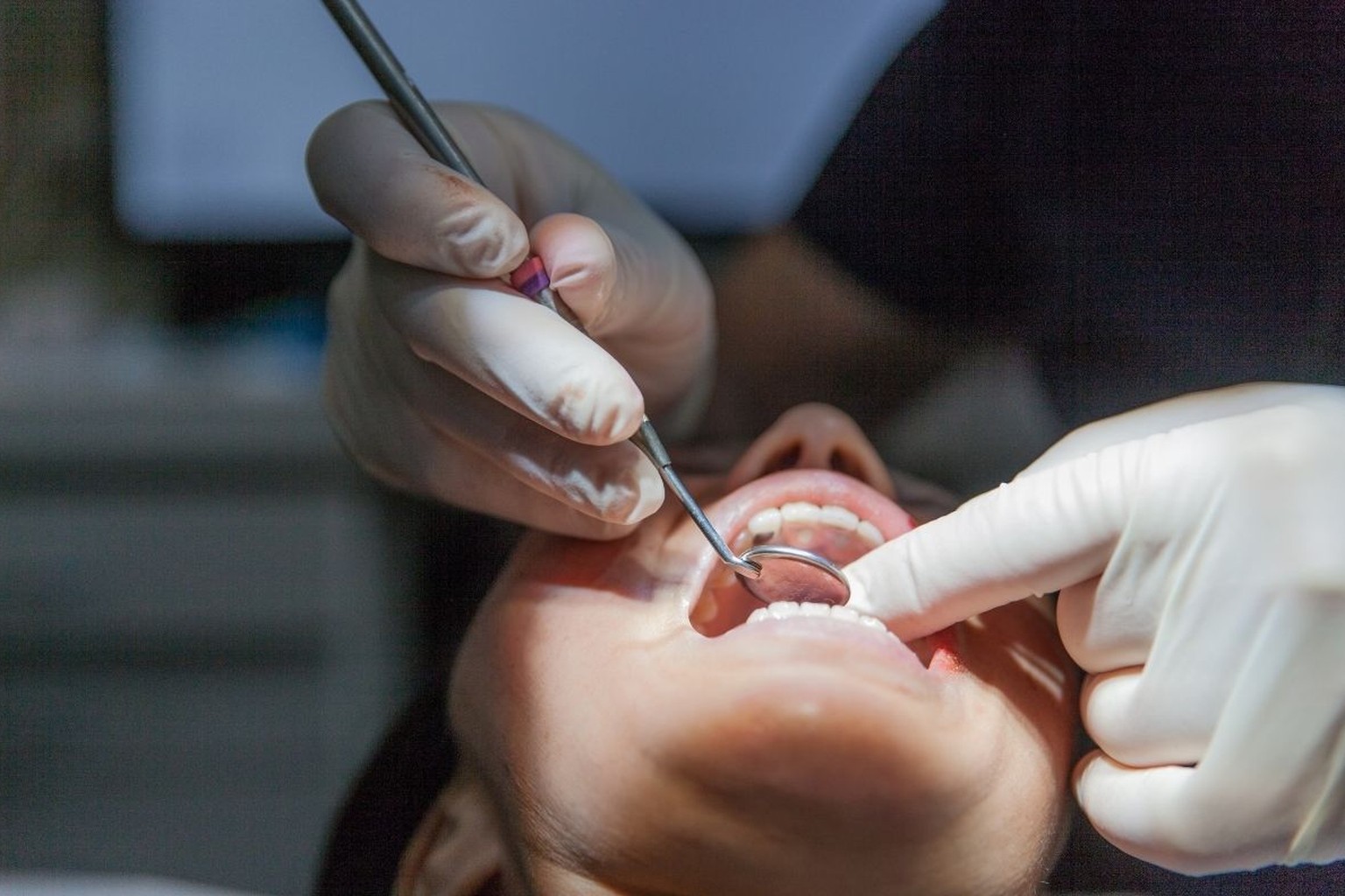Mani con guanti in lattice esaminano la bocca aperta di un paziente con specchietto e sonda dentale metallici